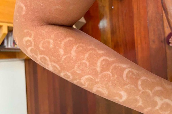 Clínica é obrigada a pagar mais de R$15 mil após deixar advogada patense com diversas queimaduras