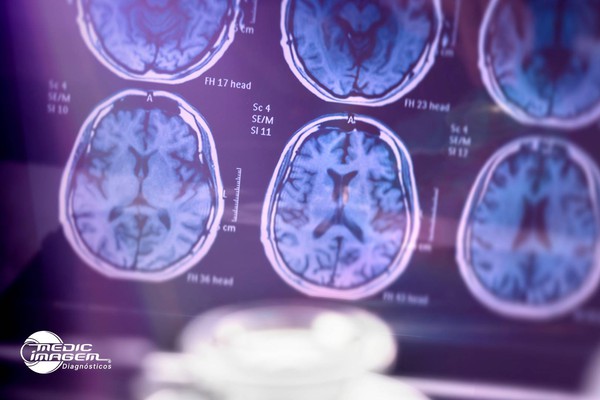 Fevereiro Roxo: a importância dos exames de imagem na luta contra doenças neurológicas