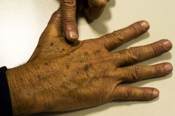 Brasil terá 704 mil novos casos de câncer por ano até 2025, diz Inca