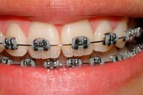 Projeto Aparelho Para Todos abre vagas em Patos de Minas para instalação de aparelho dental