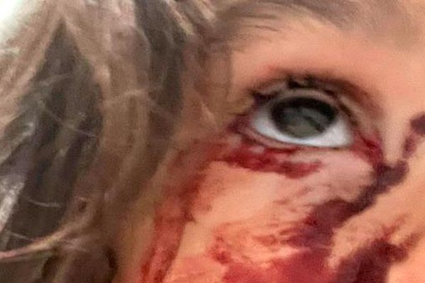 Garota de 4 anos é atacada por cão de rua enquanto brincava dentro de condomínio em Patos de Minas