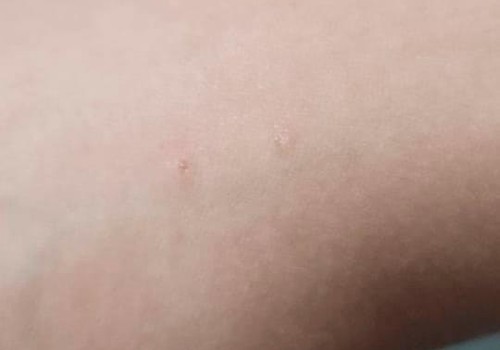 Garoto de 9 anos é mordido por morcego enquanto tomava banho em Patos de Minas